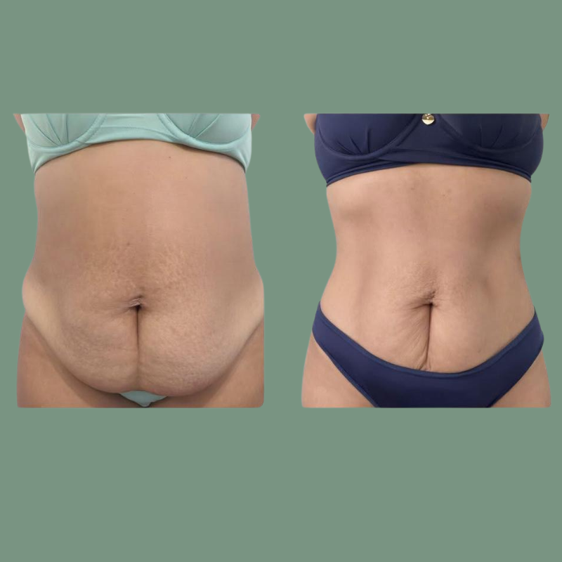Erica Ferreira Dermapeel - Caxias do Sul Antes e Depois
