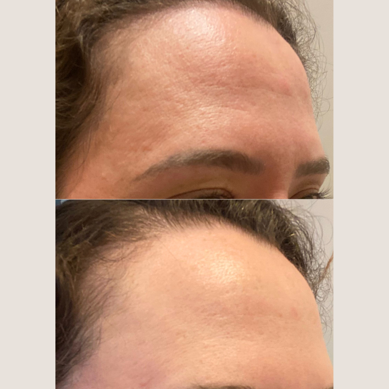 Gabriela - Brasília Peeling